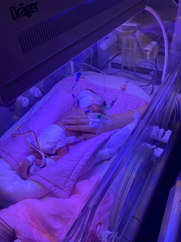 Harriet premature birth using hypnobirhting in dartford